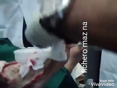 Diabetic foot mutilation