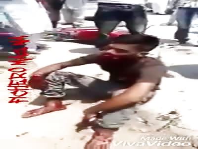 Motorcycle Accident Leaves Man with Both Hands Dangling