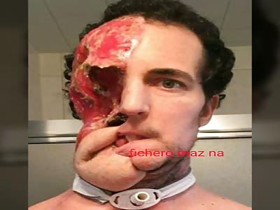 The cancer deformed the face but does not stop smiling