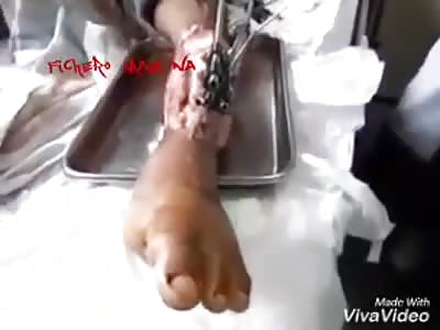 Repairing broken bone