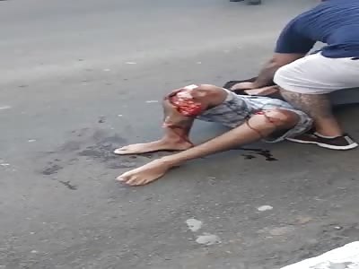 Motorcycle accident with exposed fracture