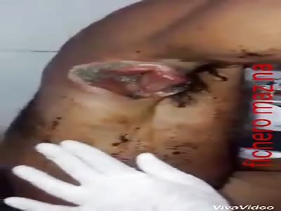 Man has vagina in the armpits