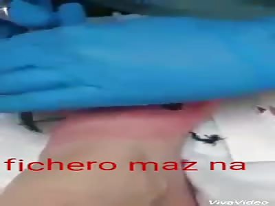 Extract nail from one foot