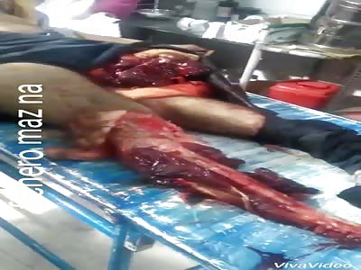 Man loses his feet in train accident !!!