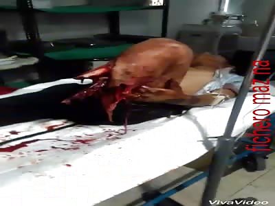 Accident leaves man without foot