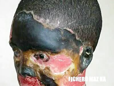 woman attacked with acid