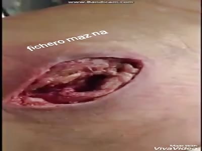 VAGINA ON BACK: man with cancer runs out of spine