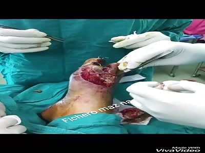 WTF: gangrenous foot