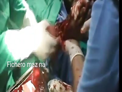 MAN LOSES HAND PAJERA