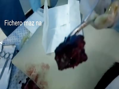 EXTRACTION OF STRANGE SHOULDER OBJECT