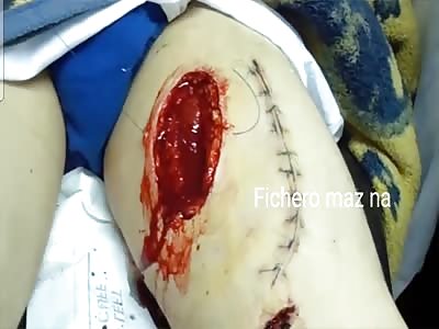 suturing a cut of a machete