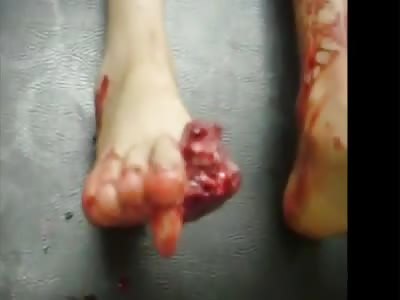 he runs out of thumb