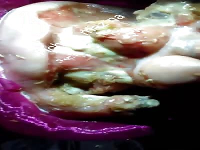 FOOT WITH DIABETES ENVUELTO ESTILO BURRITO