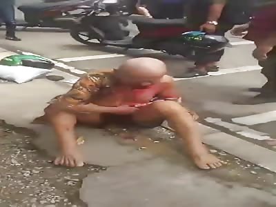 MAN LOSES HAND IN ACCIDENT