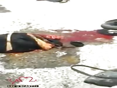 WOMAN LOSES FOOT IN ACCIDENT