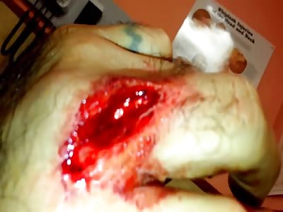 WOUND IN FINGER