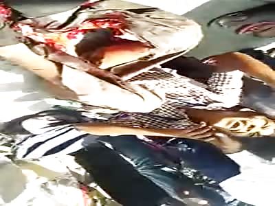 Poor Guy with Nasty Leg Break has her Foot Flopping around 