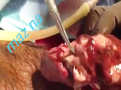 WTF Gangrena de Fournier