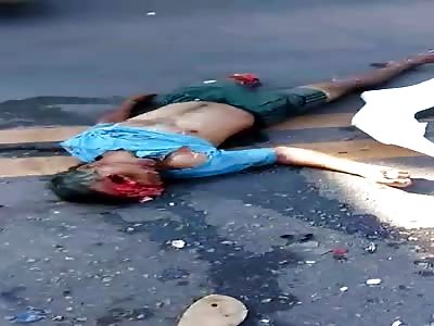 Vacated Skull...Man legt with No Face and No Brain after a Horrific Accident 