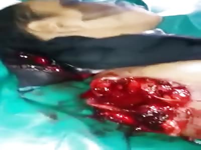 Guy with Arm Ripped Clean off is in a Complete State of Shock 