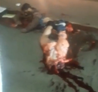 Sliced in Half after a Suicide by Truck