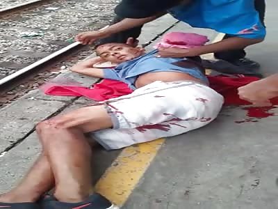 Guy in Shock with Arm Torn from Body in a Failed Suicide