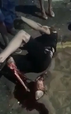 HOLY SHIT: Leg Grinded to the Bone