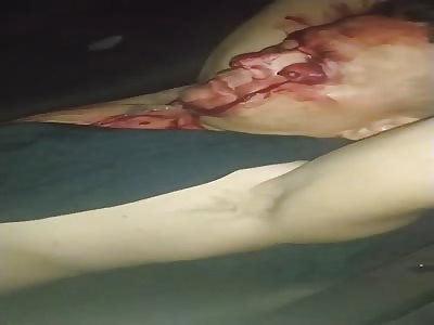 Sickening: They Popped His Eye Out...