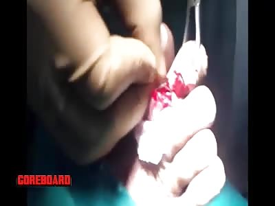 Diabetes Toe Amputation Rap