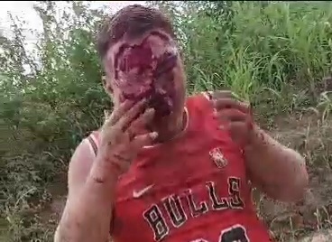 Face Skin Peeled In Motorcycle Accident