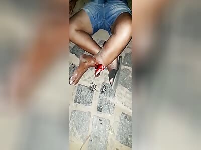 Woman suffers accident with serious exposed fracture