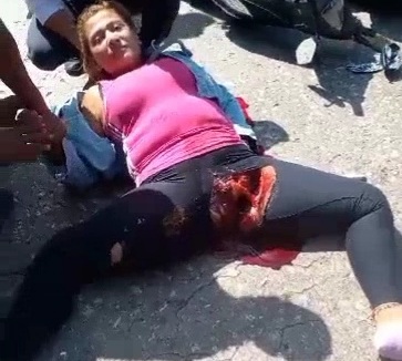 Woman's Vagina Ripped WIDE Open after BRUTAL Motorcycle Accident (Full)