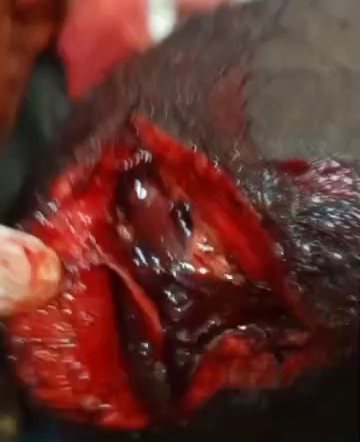 Brain exposed due to brutal machete attack 