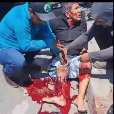 Horrific leg injury after motorcycle accident 