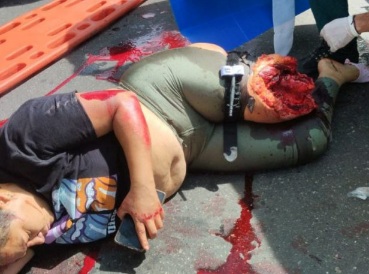 Female Biker Leg Obliterated after Traffic accident 