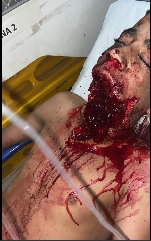 DAMN: Dude Shot in the Mouth with a Shotgun!