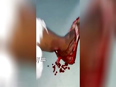 Shit leg with exposed fracture 