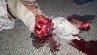 Horrific leg injury after brutal accident 