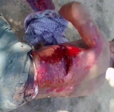 Horrific machete wound 