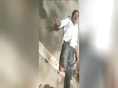 Victim with terrible exposed fracture in accident 