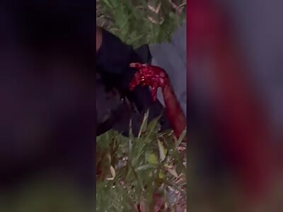 Mutilated in an accident