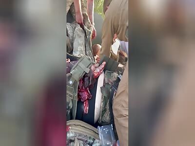 Badly Wounded Ukros From Fighting in Kleshchevka