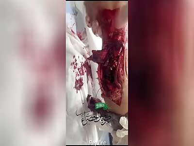 Palestinian whit his leg wasted 