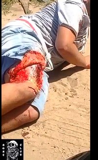 man suffered grazed leg