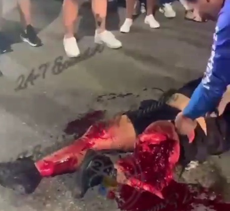 Horrific leg injury due to car crash 