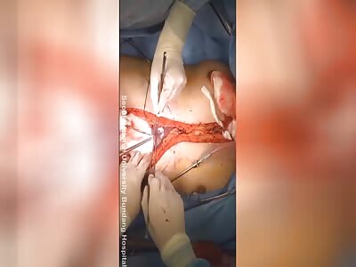 Abdominal surgery