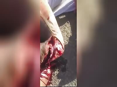 Agonal after motorcycle accident