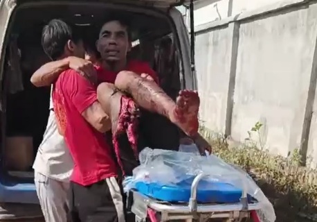 Stepped on landmine in Myanmar