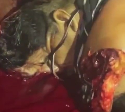 Motorcyclist gored by big truck 