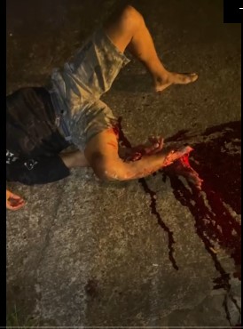 man has his foot bitten off in an accident